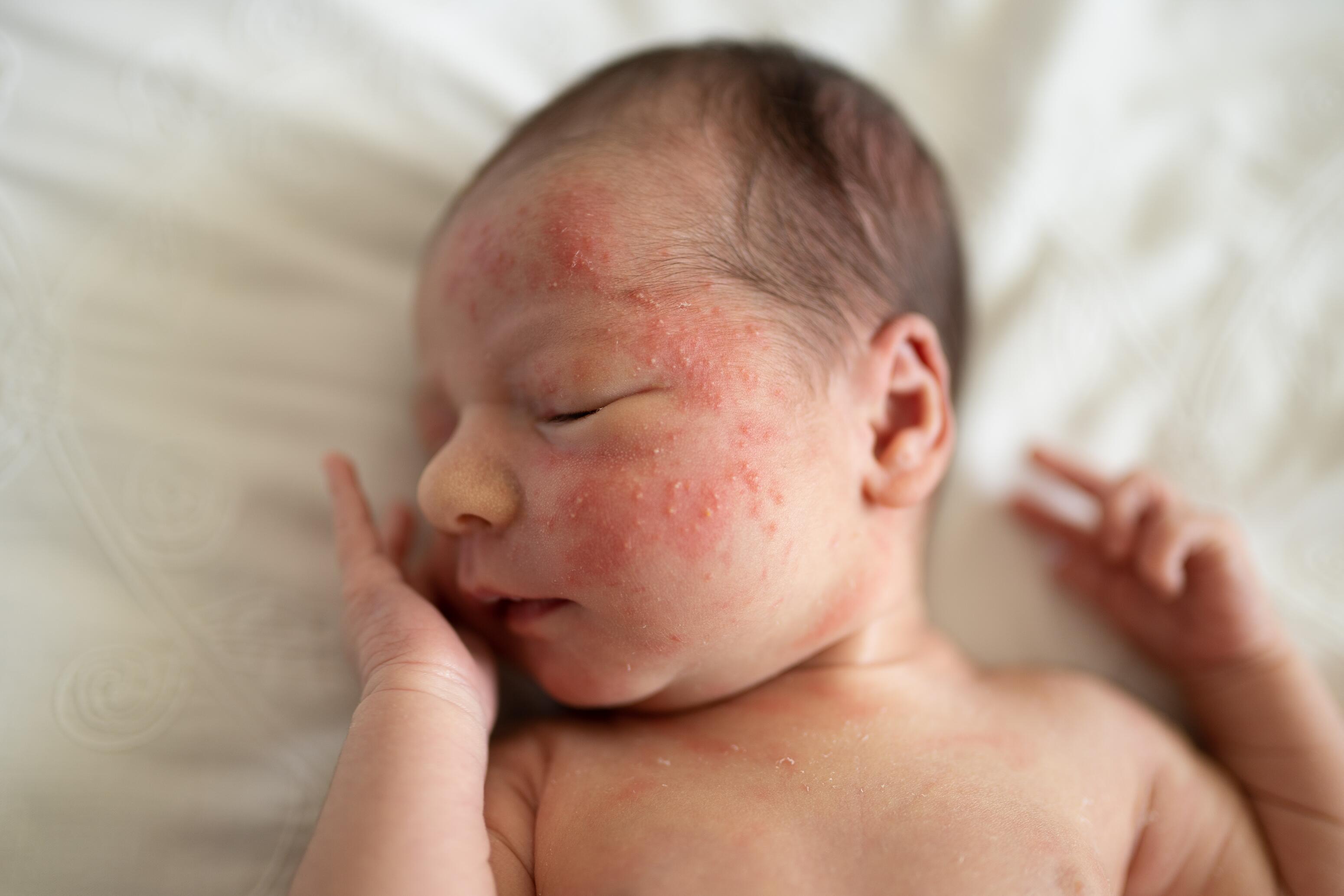 Acné du nourrisson : causes, symptômes et solutions